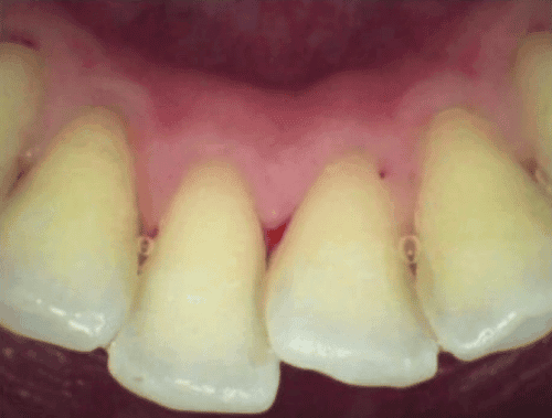 Scaling Gigi after treatment