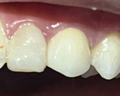 Tambal Gigi Anak + Crown after treatment