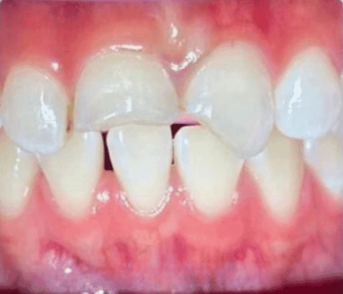 Tambal Gigi Anak before treatment