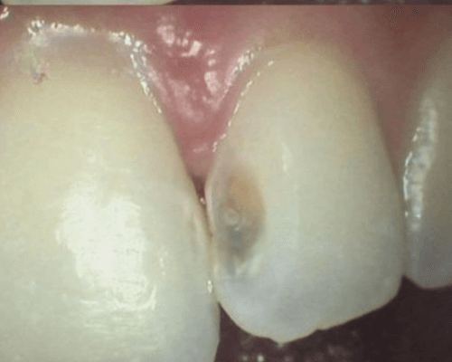 Tambal Gigi Depan before treatment