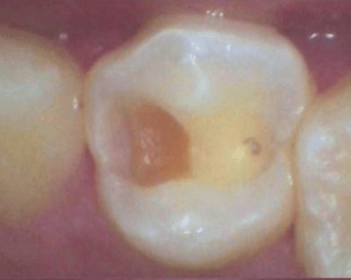 Tambal Gigi before treatment